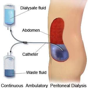 Graphic depicting how peritoneal dialysis works